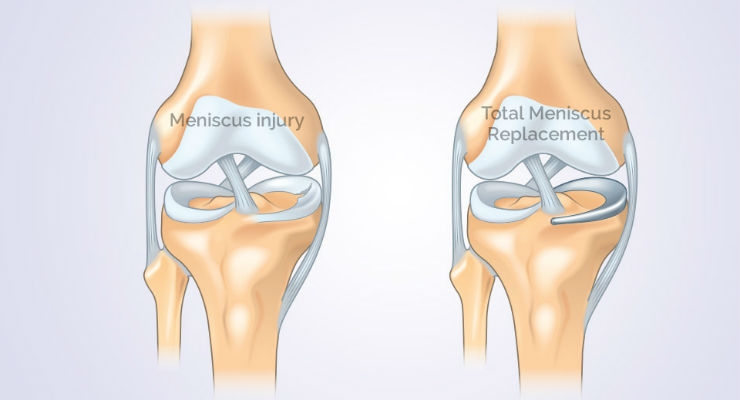 Orthonika Accelerates Development of Total Meniscus Replacement - ODT