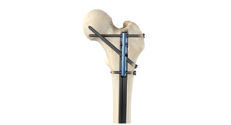 OrthoXel Orthopaedic Trauma Device Co. Receives CE Mark Clearance
