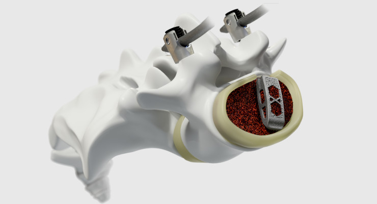 NASS News: Medtronic Launches Adaptix Interbody System | ODT