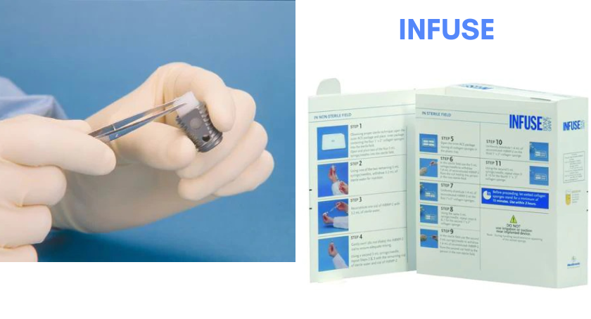 Infuse Bone Graft Approved for One- and Two-Level TLIF Procedures