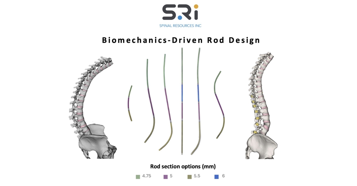 Spine Rod Position Landmark Universal Clearance for SRI's Bezier Spinal Rod System