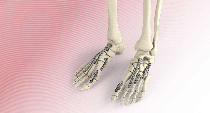 Orthopedic Extremity Implants Are Precision in Miniature
