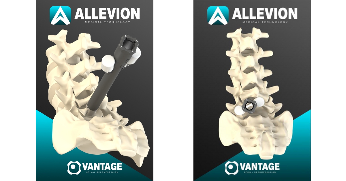 Allevion Wins FDA Nod for Vantage Disposable Spinal Decompression Kit