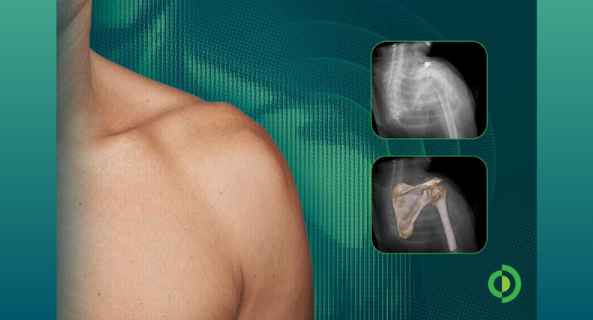 Advita Ortho Highlights New Research on AI-Generated Shoulder Digital Twins