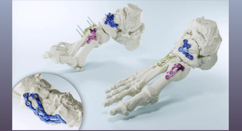 FDA Clears New Lower Leg Tibia/Fibula Solution for MedCAD’s AccuStride