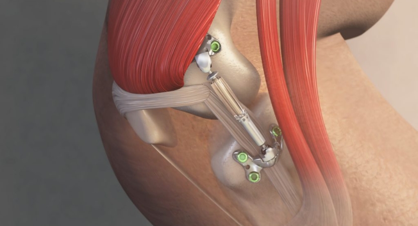 5-Year Data Backs Moximed’s MISHA System for Knee Osteoarthritis