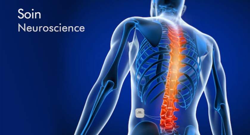 Biotronik Neuro Buys Spinal Cord Stim IP from Soin Neuroscience